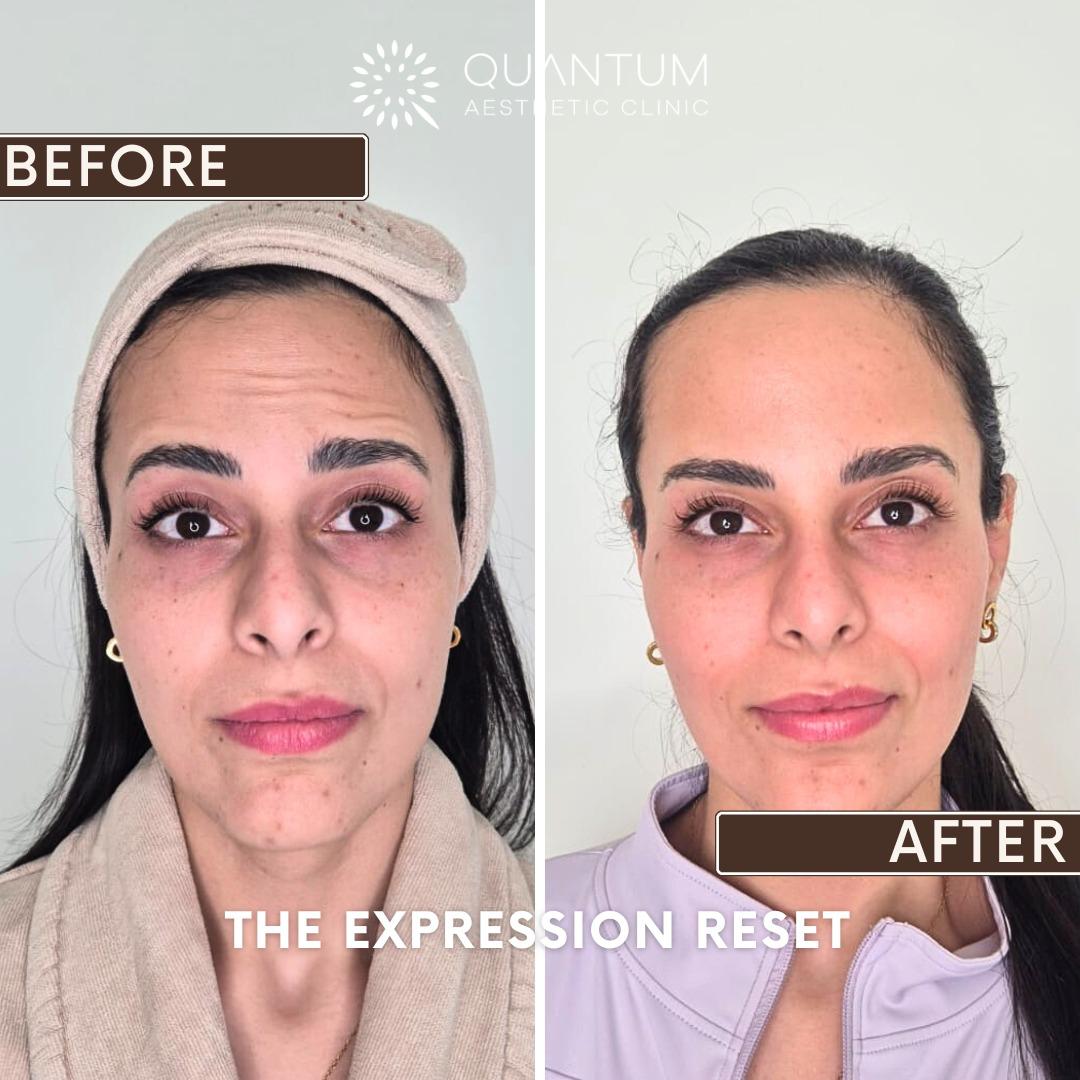 Before and after results